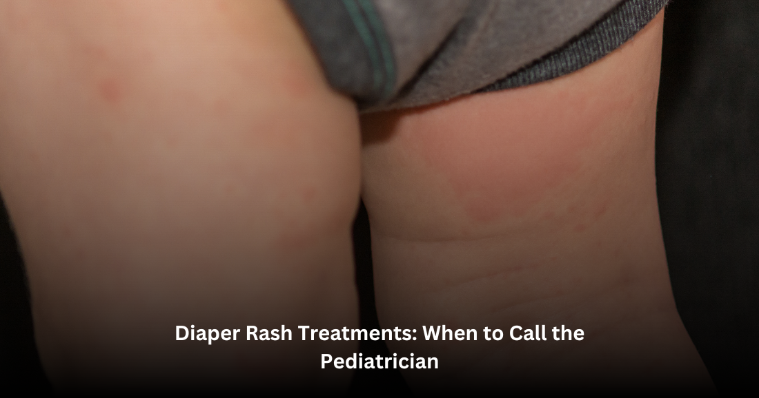 Baby showing rashes caused by diaper